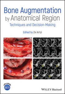 Bone Augmentation by Anatomical Region - Techniques and Decision-Making - 2866220209