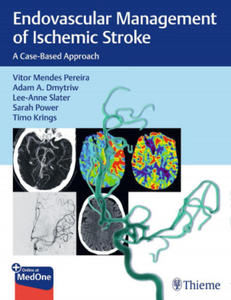 Endovascular Management of Ischemic Stroke - 2875679505