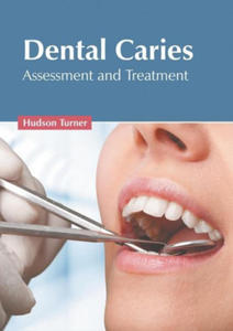 Dental Caries: Assessment and Treatment - 2867628027