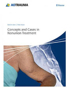 Concepts and Cases in Nonunion Treatment - 2867591615