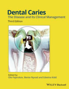 Dental Caries 3e - 2865189761
