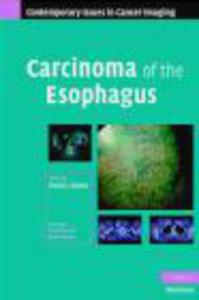 Carcinoma of the Esophagus - 2822222681