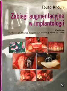 Zabiegi augmentacyjne w implantologii - 2848937034