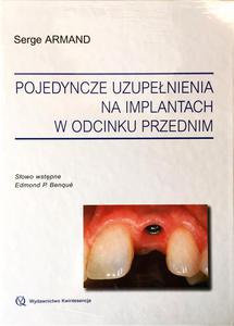 Pojedyncze uzupenienia na implantach w odcinku przednim - 2822221056